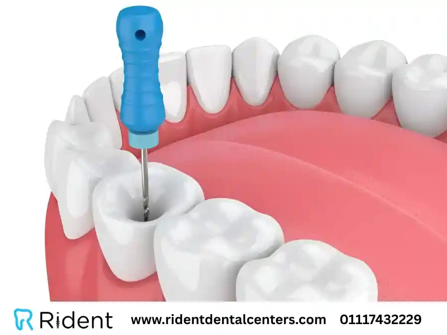 كم يستمر الألم بعد حشو العصب